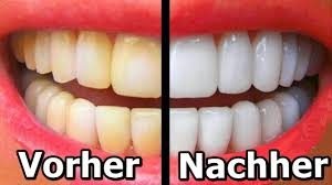 Zähne Vorher/ Nachher Vergleich 